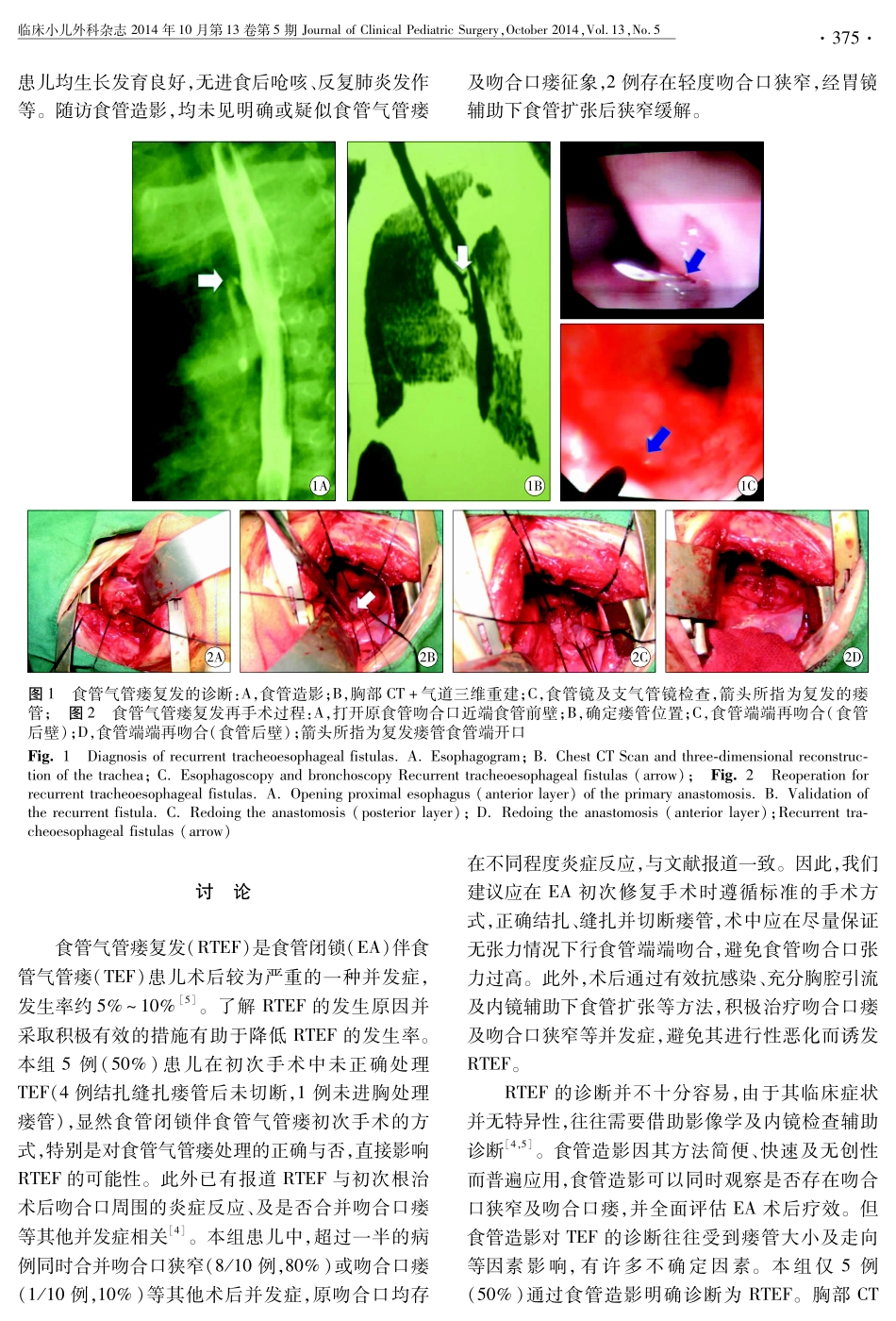 食管闭锁术后食管气管瘘复发再手术的临床分析_第3页