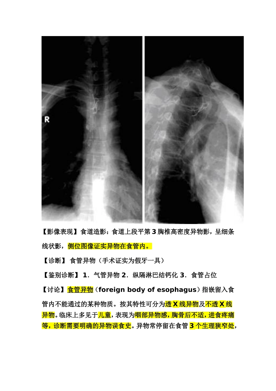食管异物与气管异物鉴别诊断_第2页