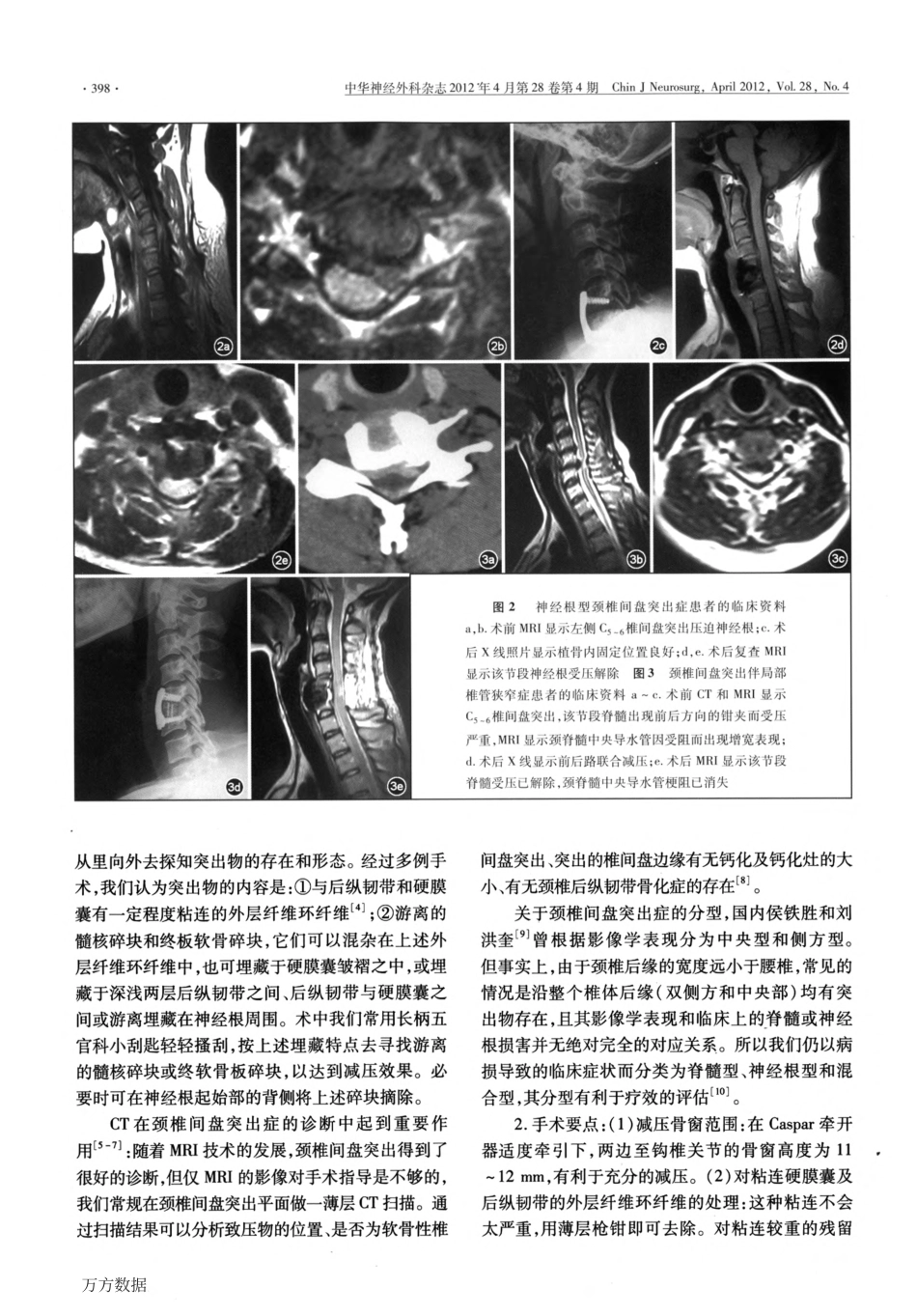 颈椎间盘突出症的手术治疗_第3页
