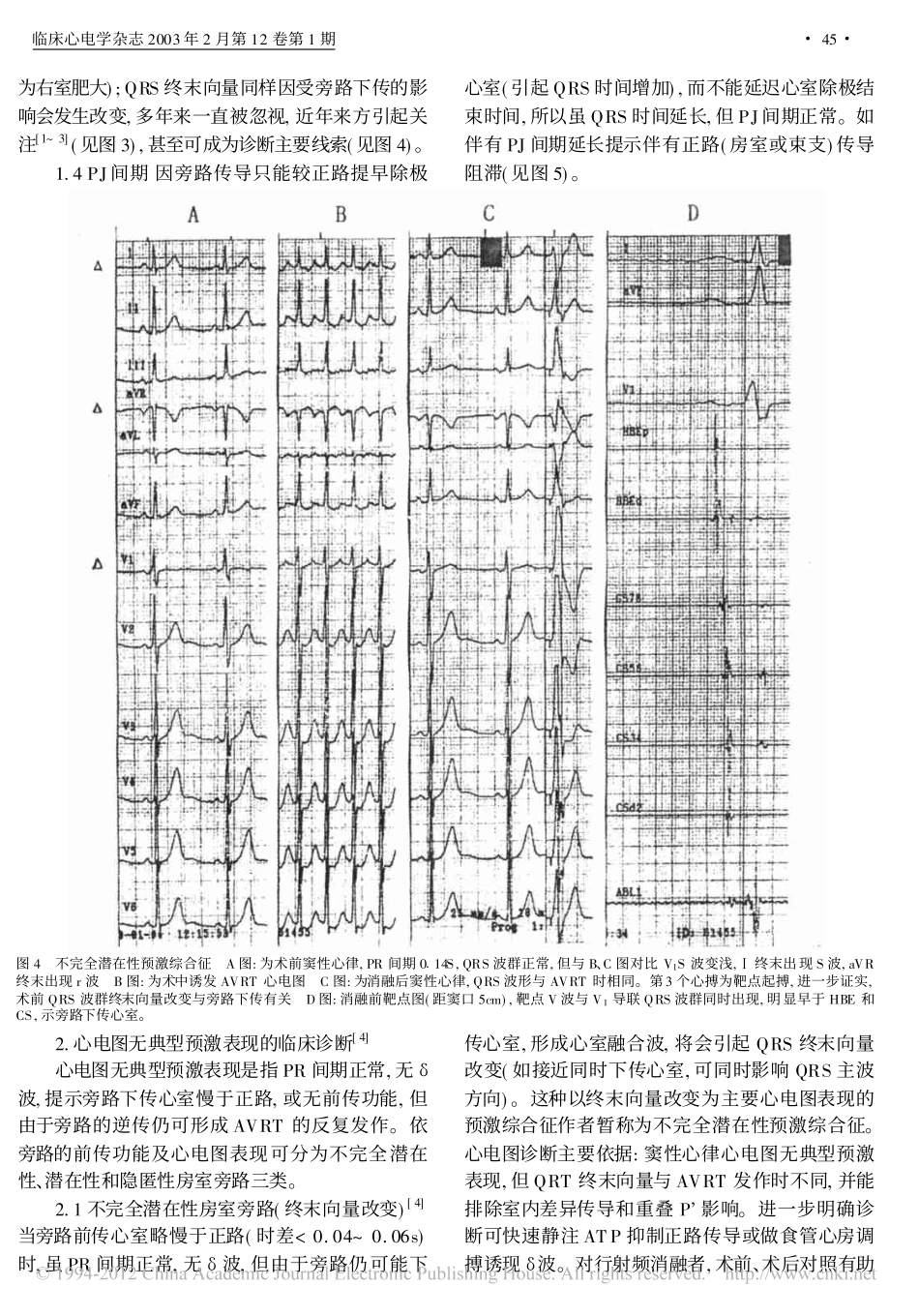 预激综合征临床心电图诊断有关问题_刘仁光_第3页