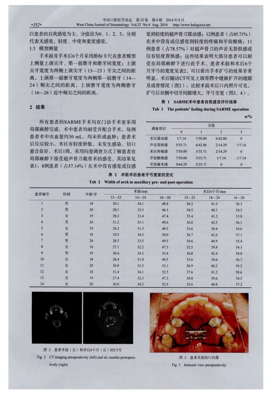 采用超声骨刀在局部麻醉下行外科辅助上颌骨快速扩弓术的临床应用_第3页