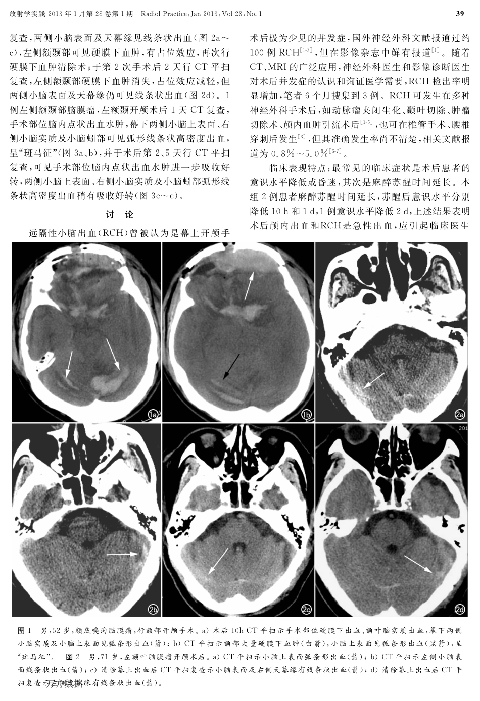 远隔性小脑出血CT表现_第2页