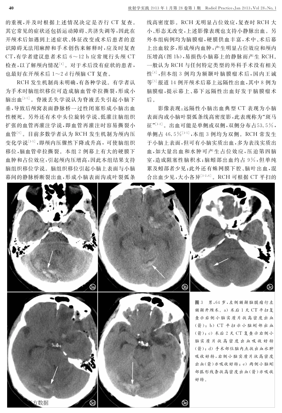 远隔性小脑出血CT表现_第3页