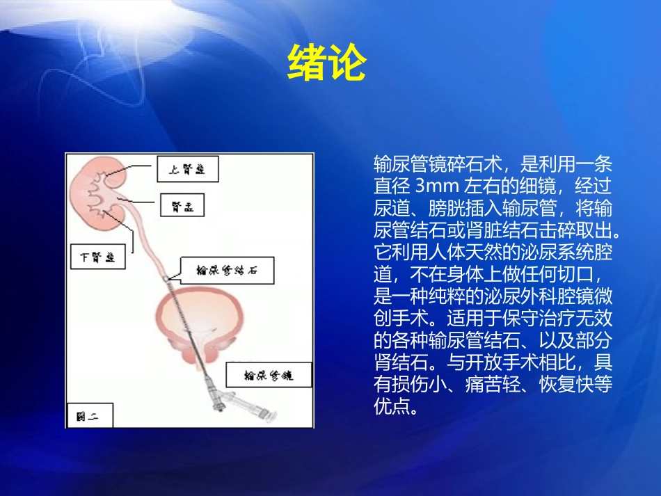 输尿管镜碎石术_第2页