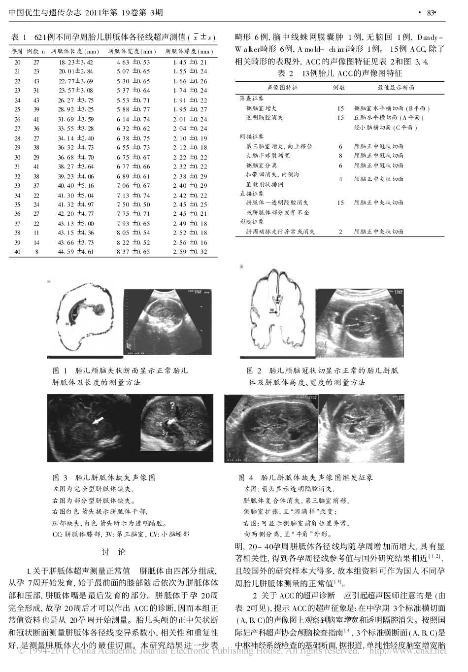 超声检测胎儿胼胝体发育及畸形_第2页