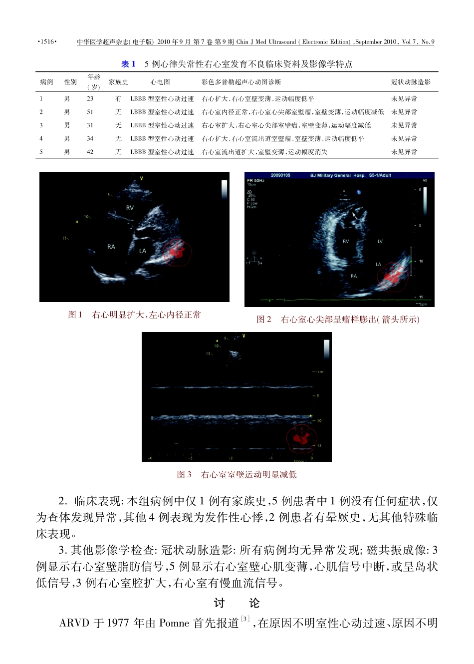 超声心动图诊断心律失常性右心室发育不良的价值_第3页
