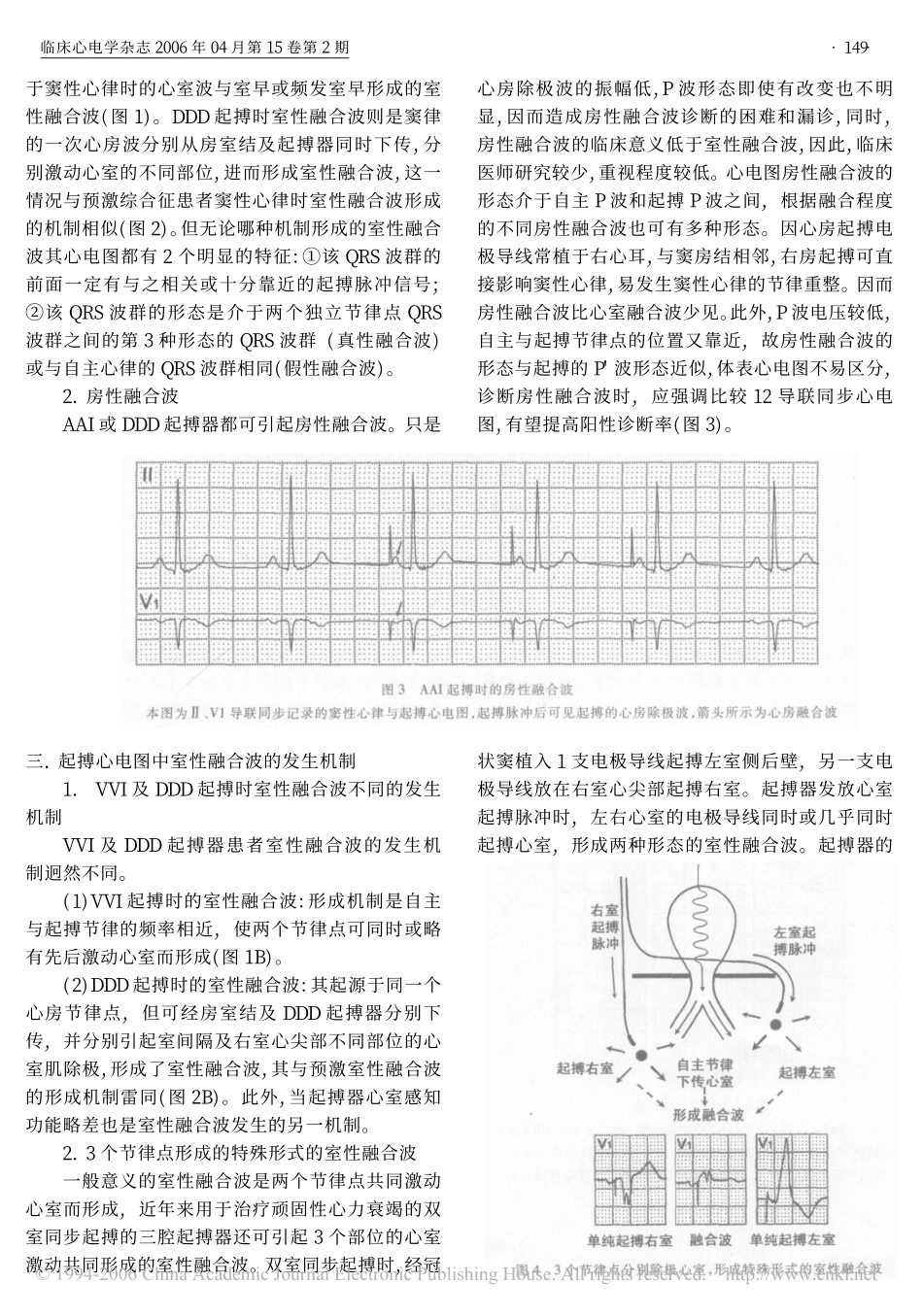 起搏心电图中的融合波_第2页