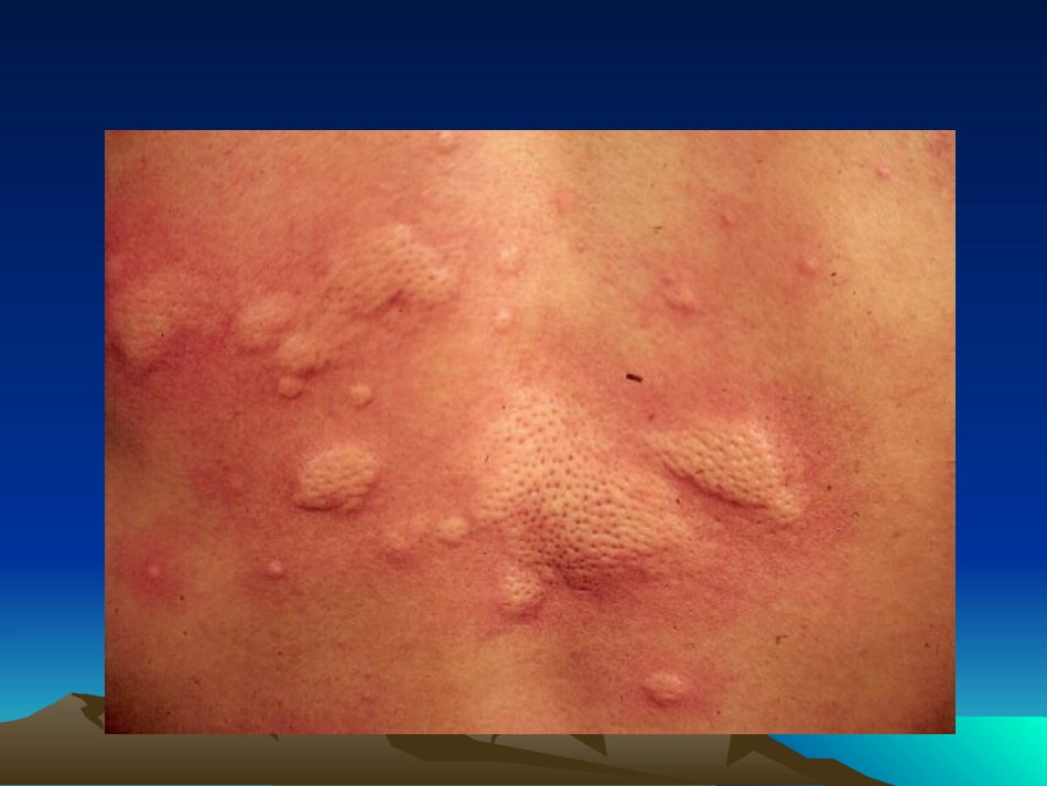 荨麻疹类皮肤病_第2页