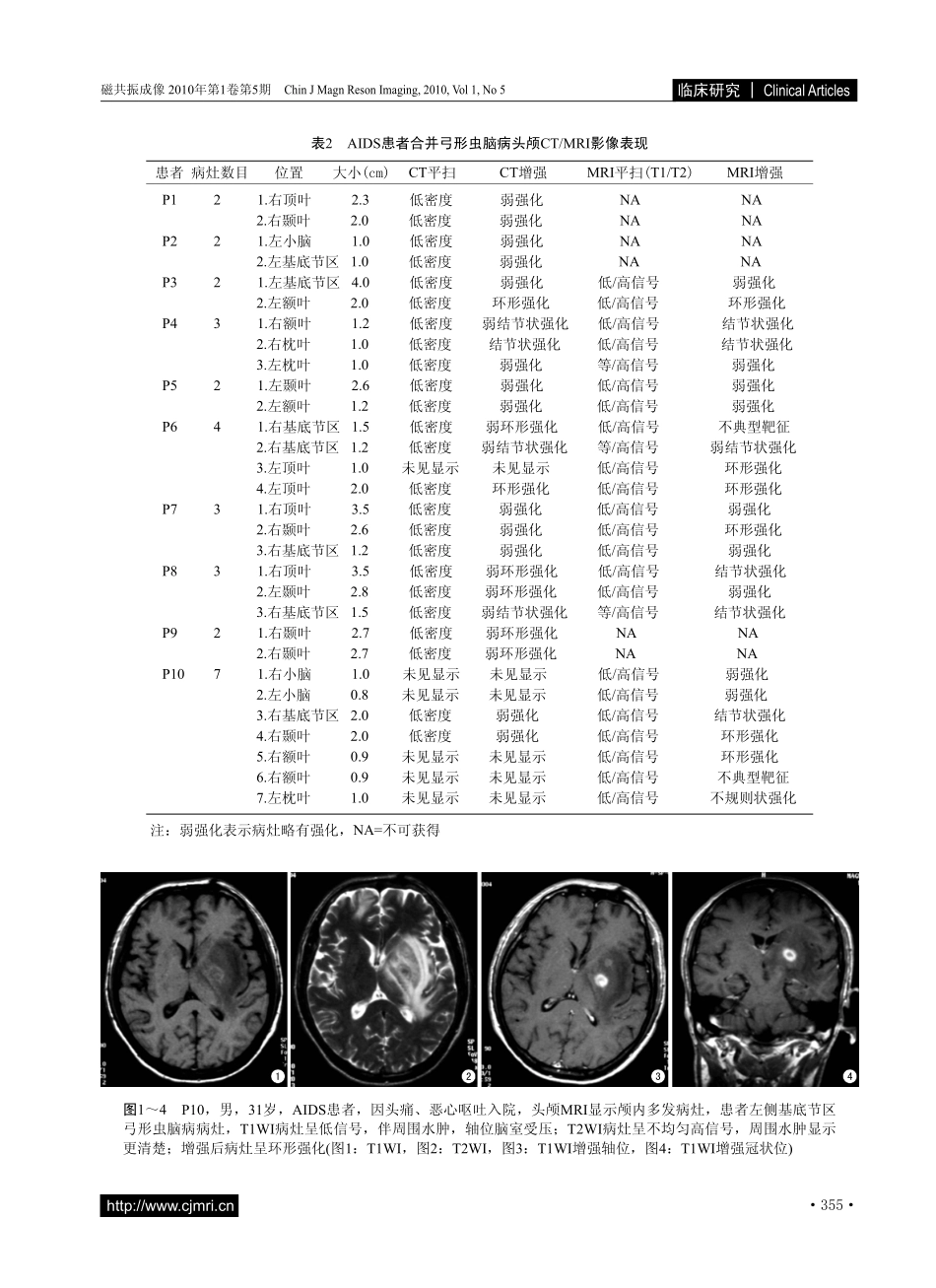 艾滋病合并弓形虫脑病的影像学表现_第3页