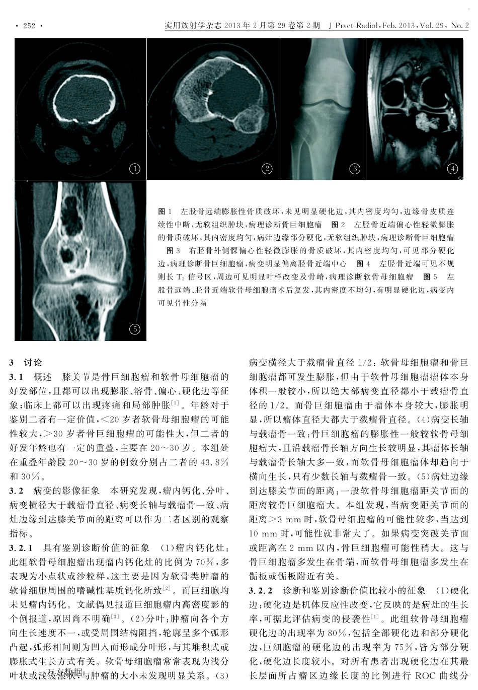 膝关节周围骨巨细胞瘤与软骨母细胞瘤影像表现分析_第3页