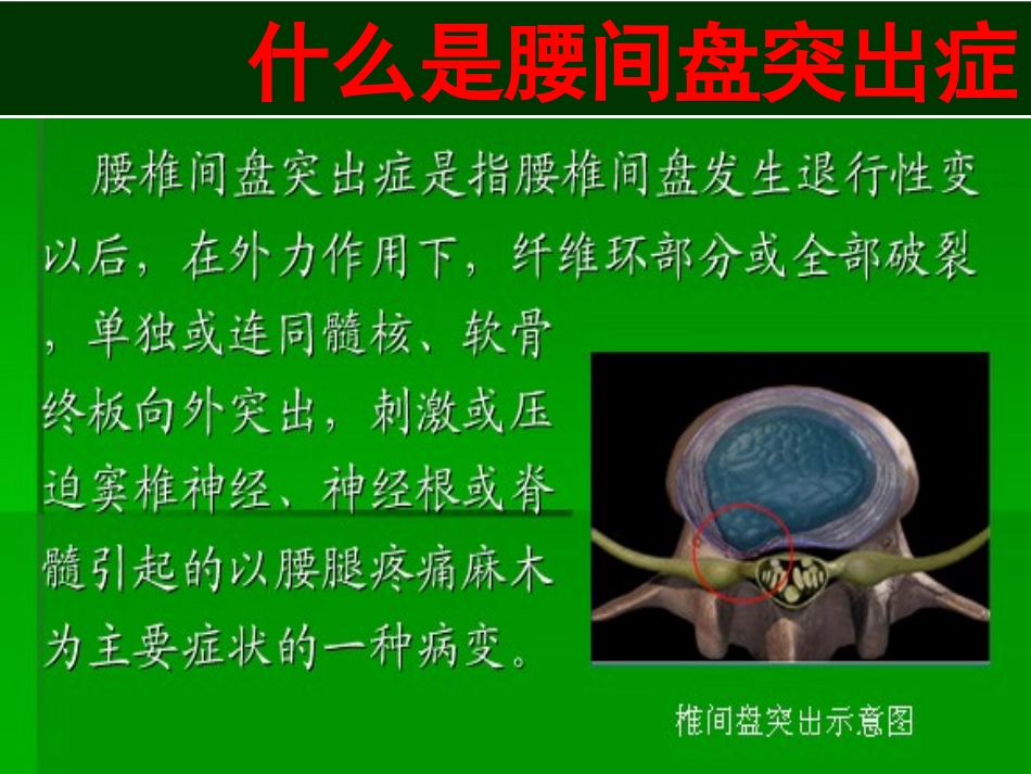 腰间盘突出症1_第2页