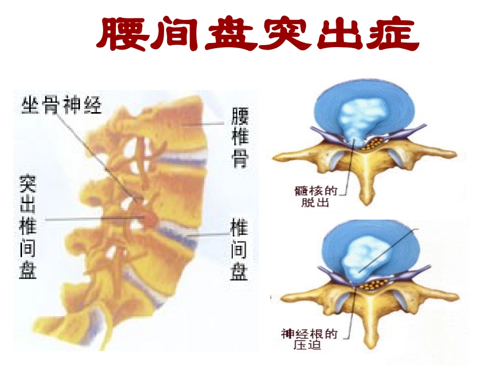腰间盘突出症1_第3页