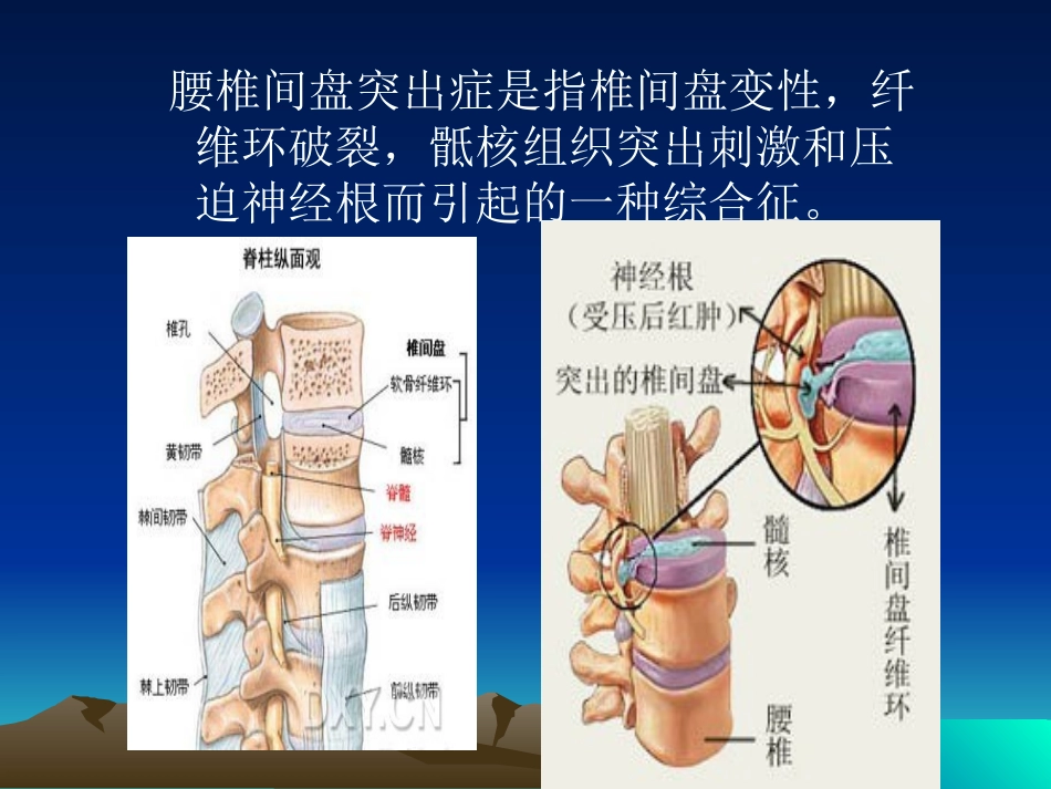 腰椎间盘突出症术前术后指导._第2页