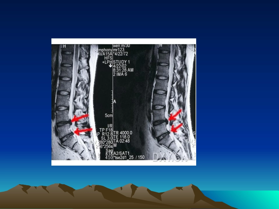 腰椎间盘突出症术前术后指导._第3页