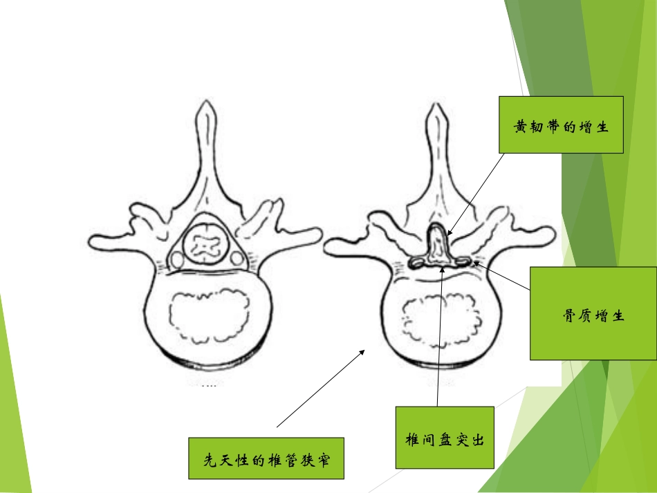 腰椎管狭窄症-(1)_第3页