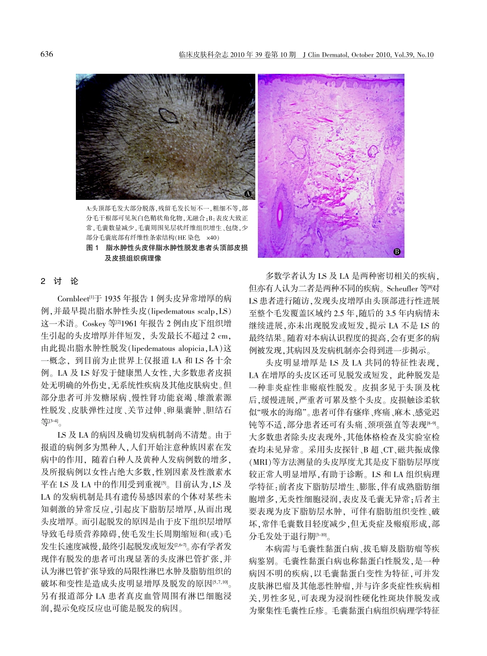 脂水肿性头皮伴脂水肿性脱发_第2页