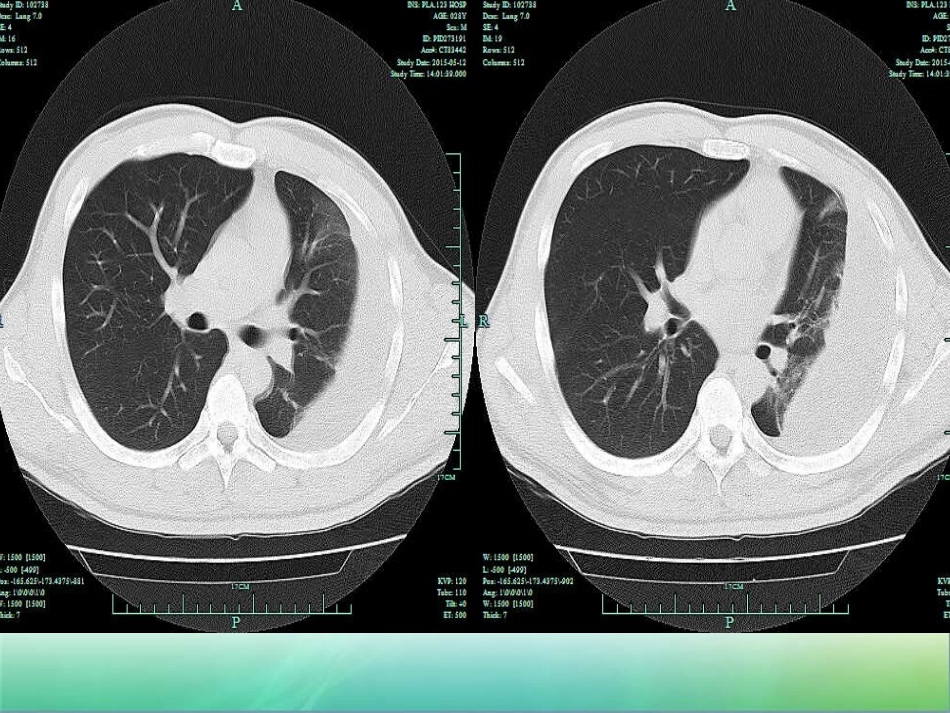 胸膜纤维板剥脱术_第3页