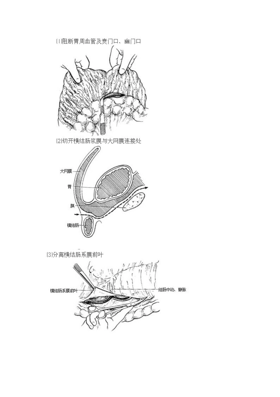 胃癌根治术全过程图解及手术常识_第2页