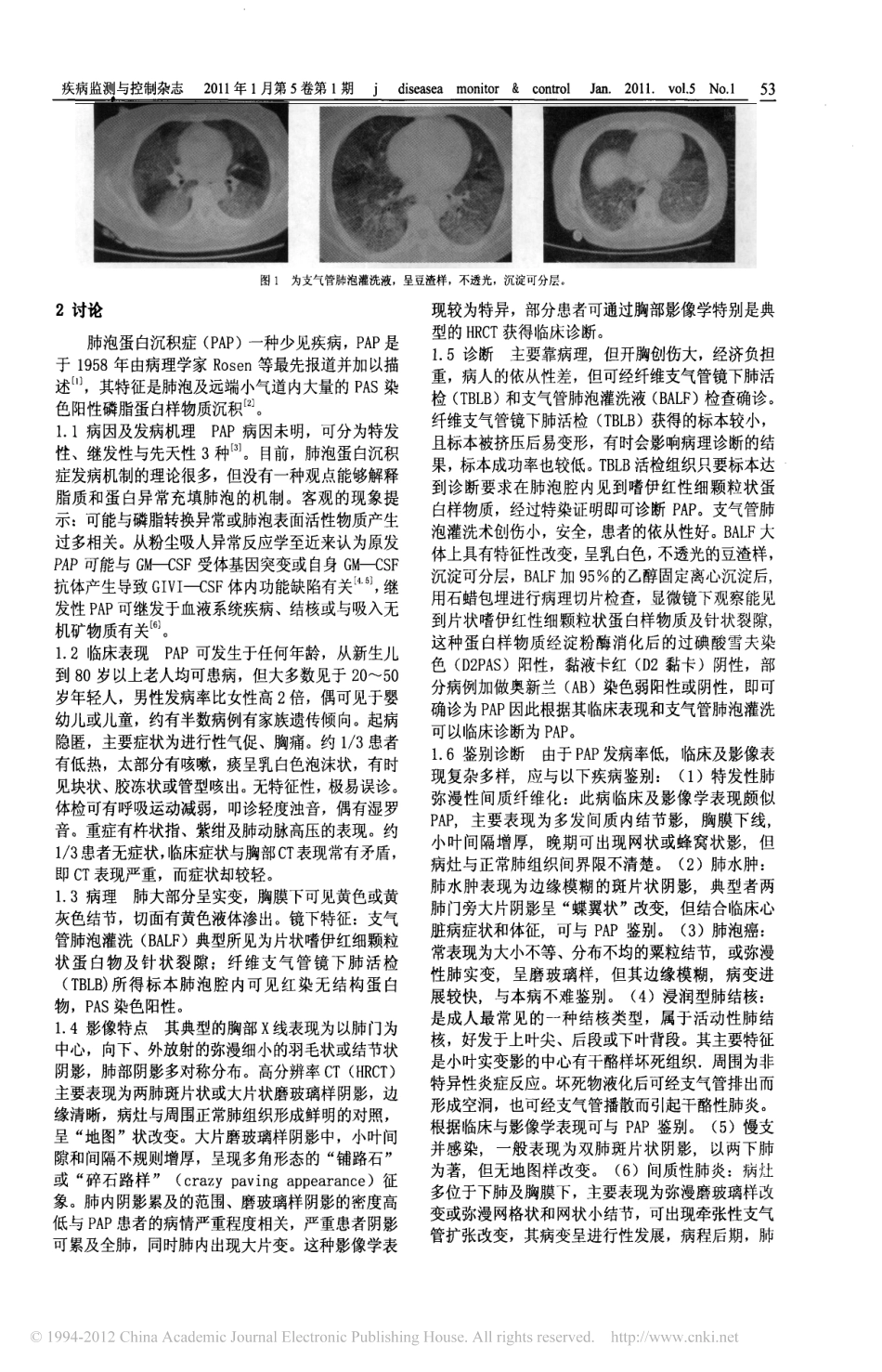 肺泡蛋白沉积症1例及文献复习_第2页