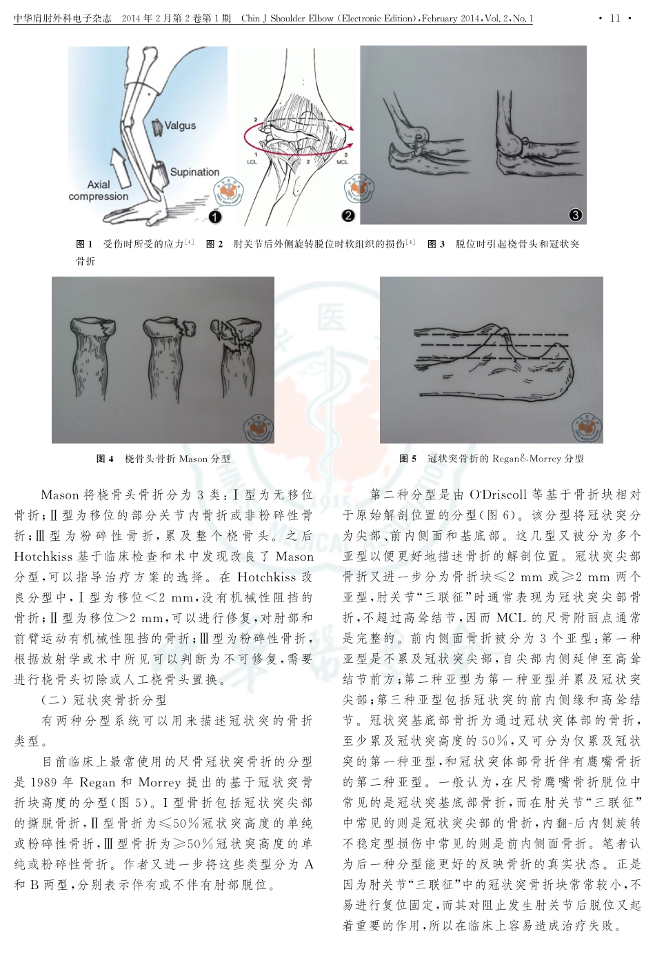 肘关节“三联征”的诊断和治疗_第2页