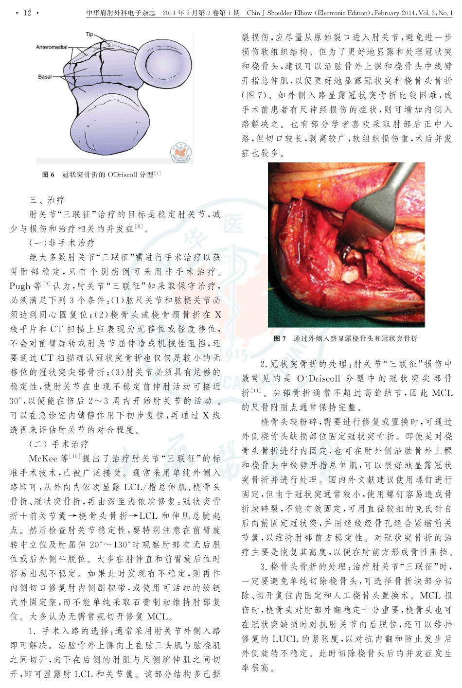 肘关节“三联征”的诊断和治疗_第3页