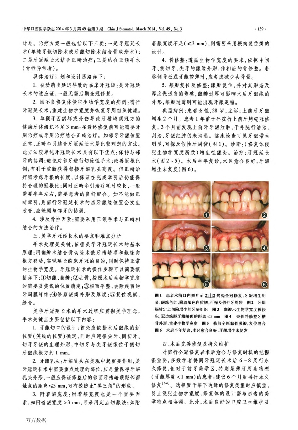 美学牙冠延长术的要点及难点分析_第2页