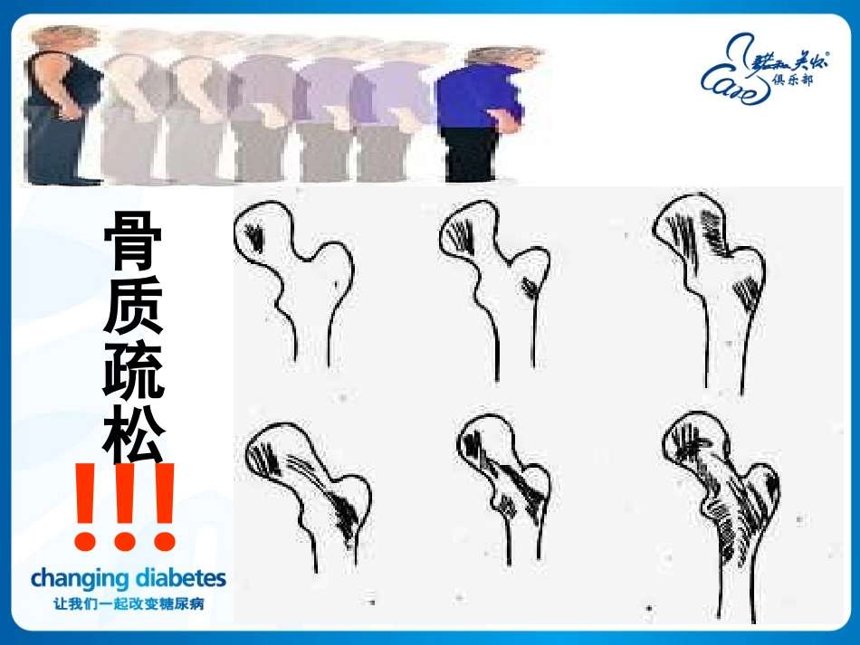 糖尿病与骨质疏松新_第2页