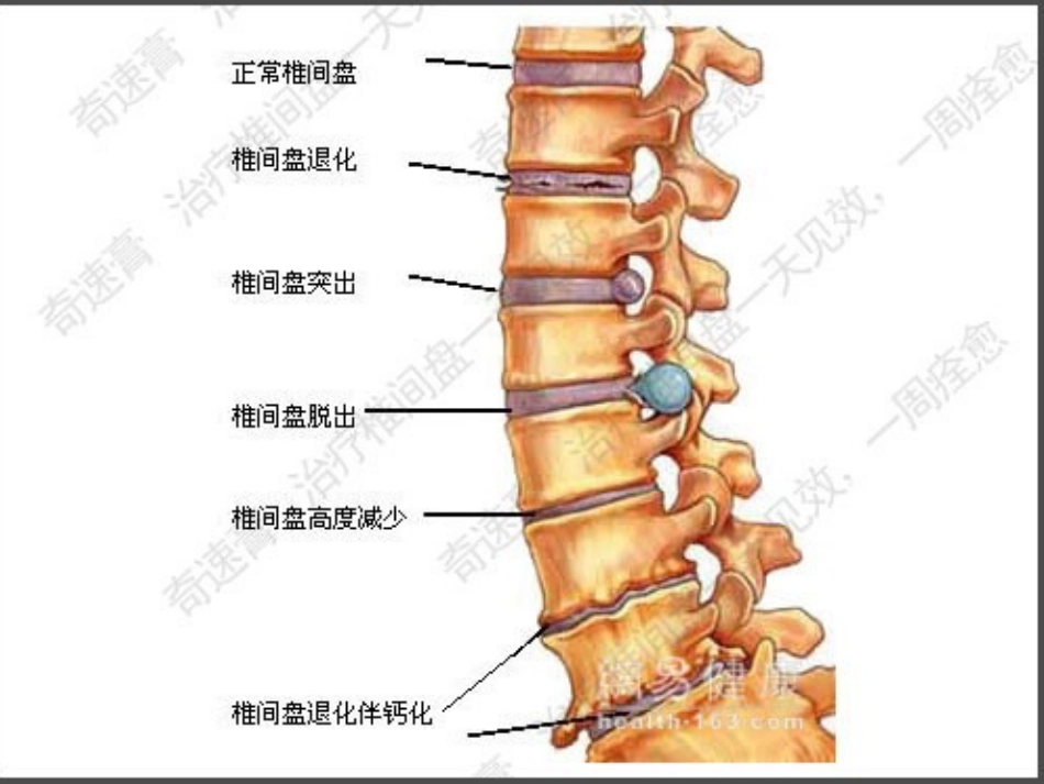 第五节_腰椎间盘突出症_第3页
