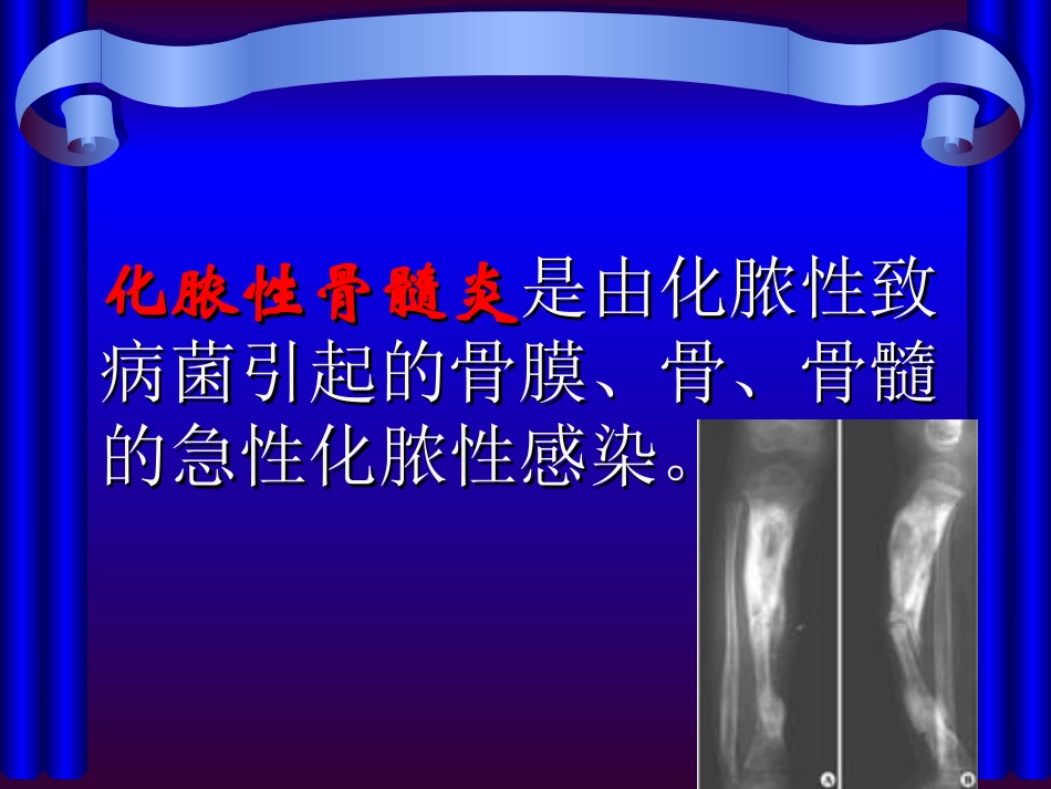 第三节_化脓性骨髓炎病人的护理_第3页