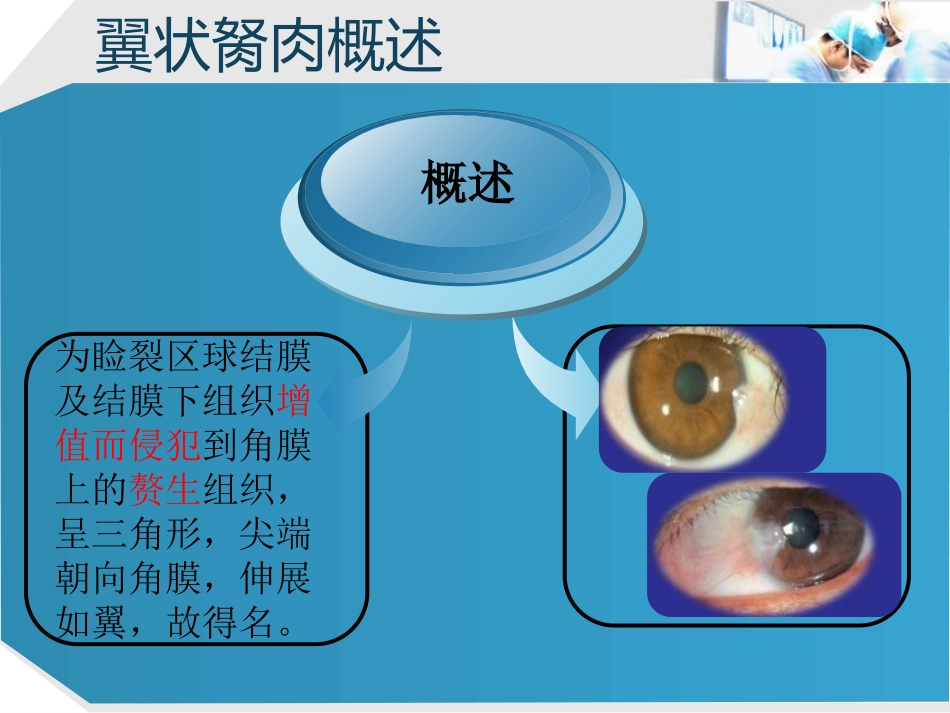 眼科翼状胬肉_第3页