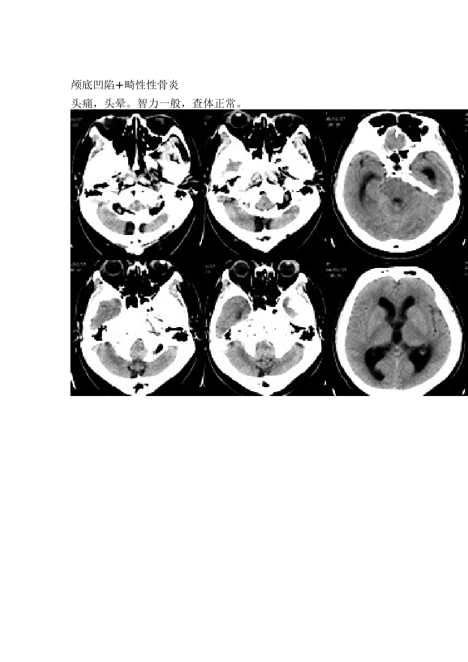 畸形：颅底凹陷_第1页