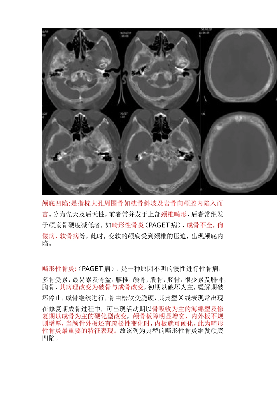 畸形：颅底凹陷_第2页