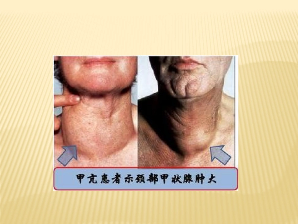 甲状腺功能亢进症(专)_第3页