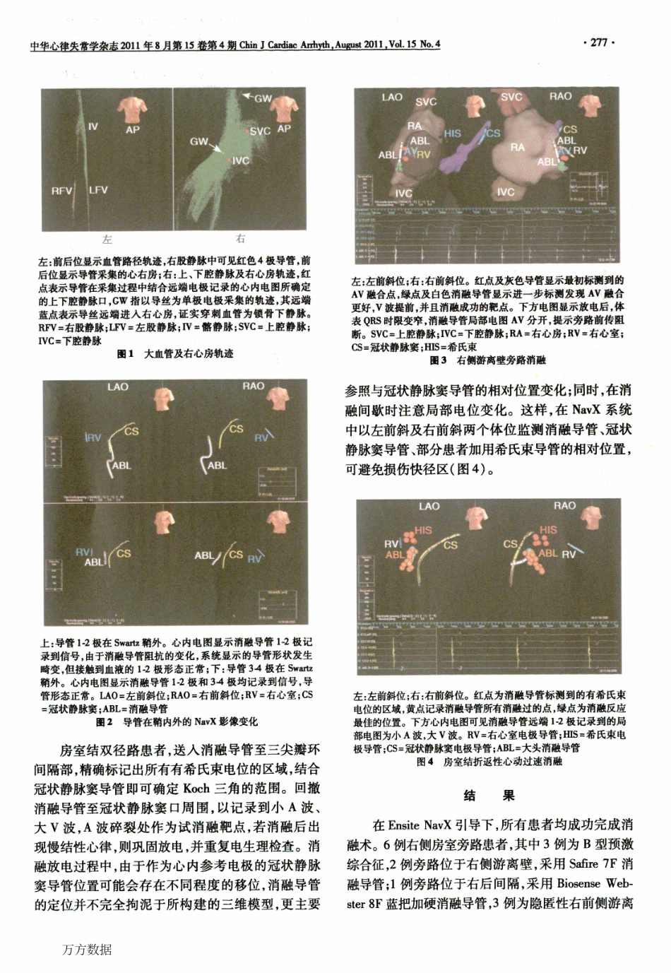消融治疗右侧阵发性室上性心动过速_第3页