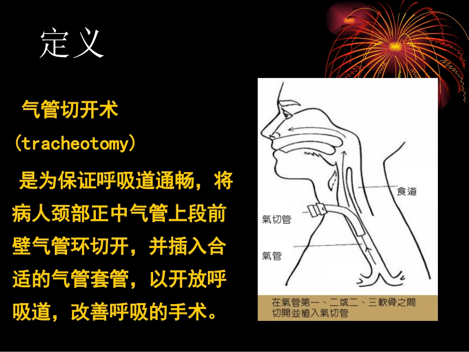气管切开的护理_第3页