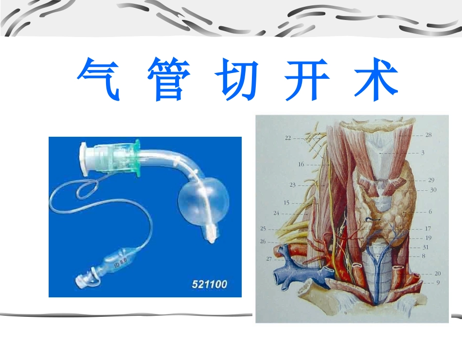气管切开术.ppt_第1页