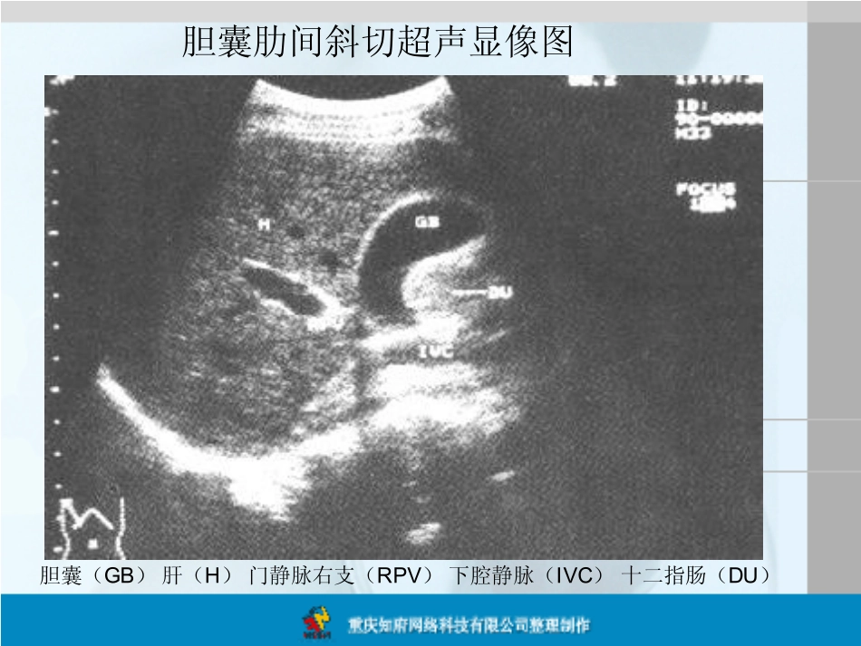 正常胆囊B超解剖图谱_第2页