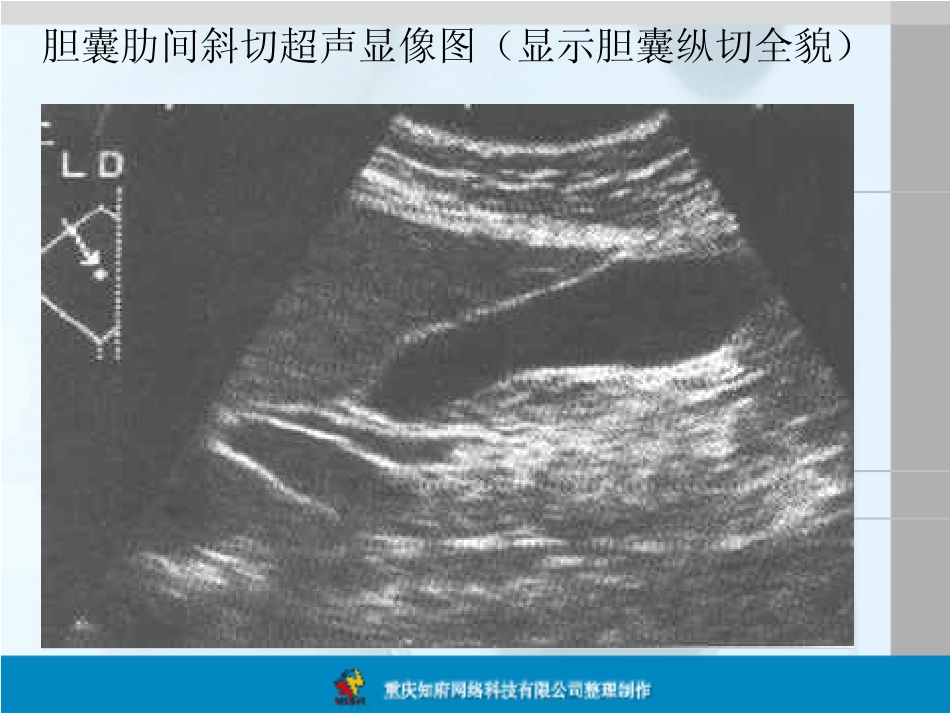 正常胆囊B超解剖图谱_第3页