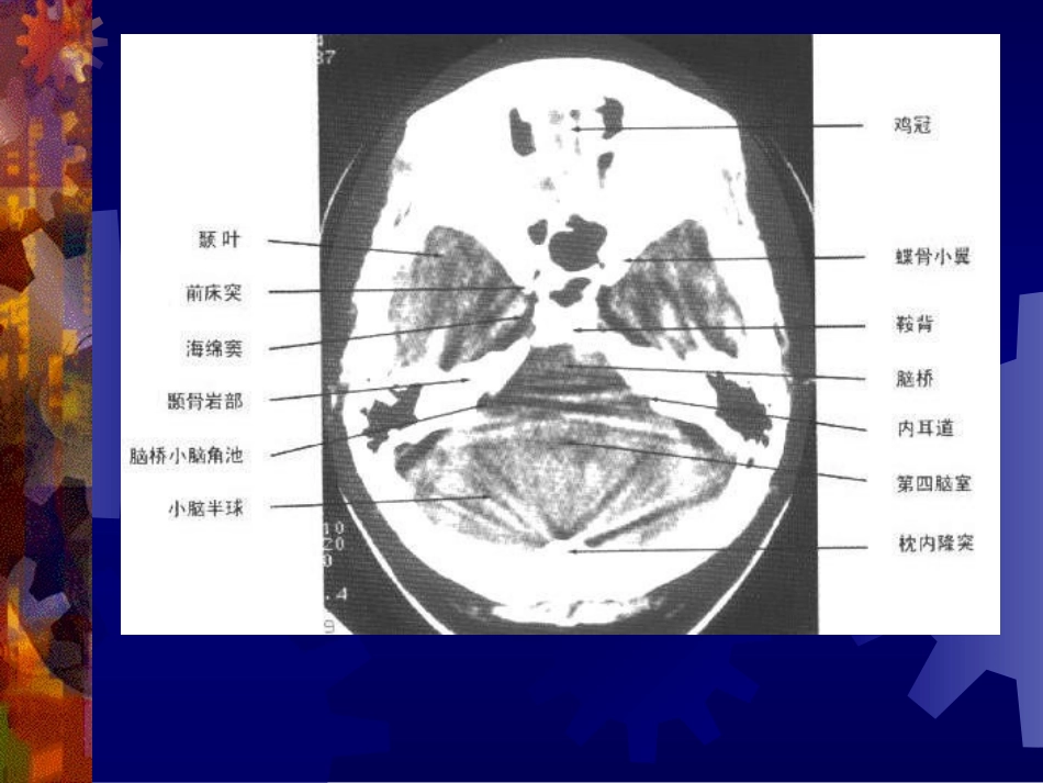正-常-头-颅-CT-及-MRI-解-剖_第3页