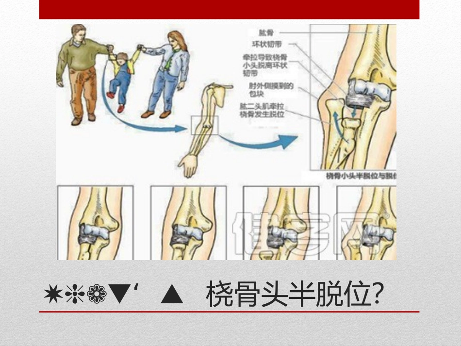 桡骨小头半脱位_第2页