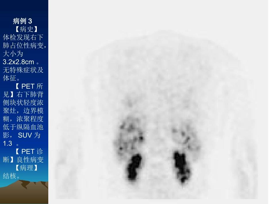 最新PET病例-PPT文档_第2页
