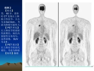 最新PET病例-PPT文档