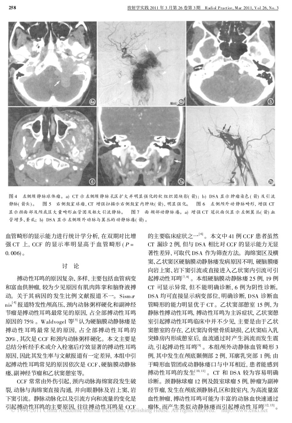 搏动性耳鸣的CT和DSA_第3页