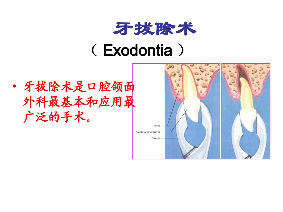拔牙术2014.9.17_第2页