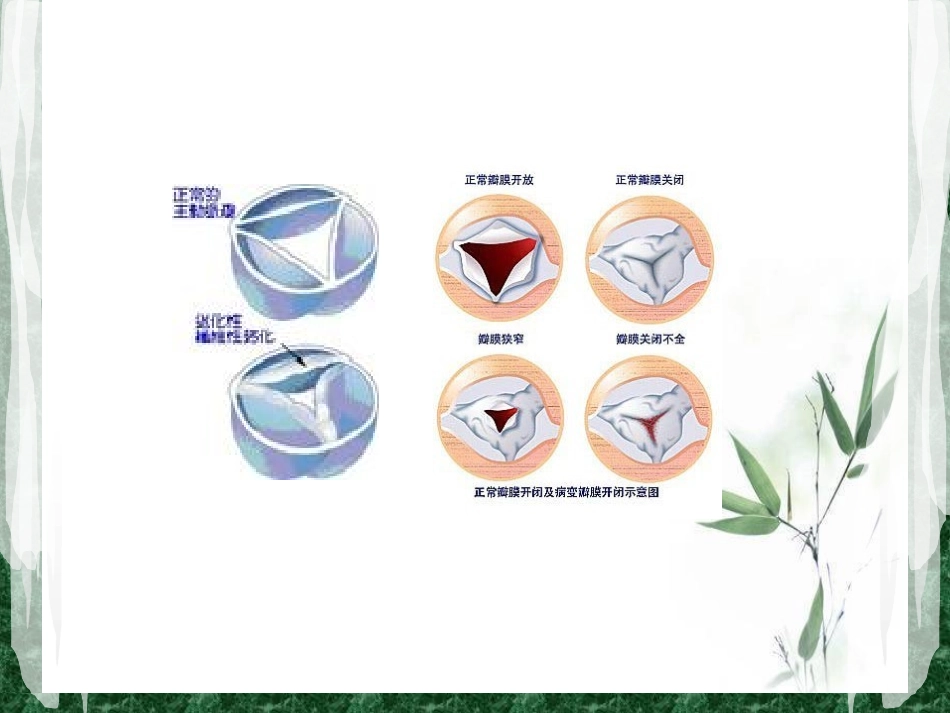 护理查房心脏瓣膜病_第3页