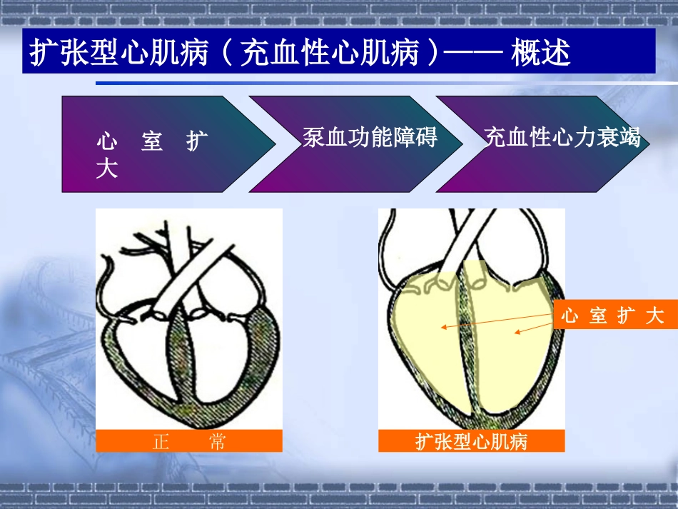 扩张型心肌病查房_第3页
