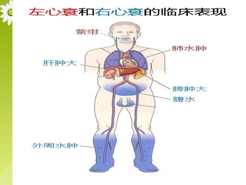扩张性心肌病第二部分_第2页
