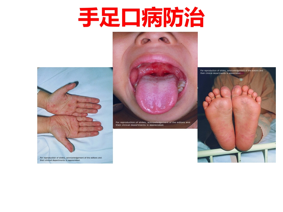 手足口病防治-(2)_第1页