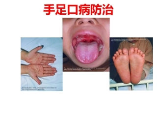 手足口病防治-(2)