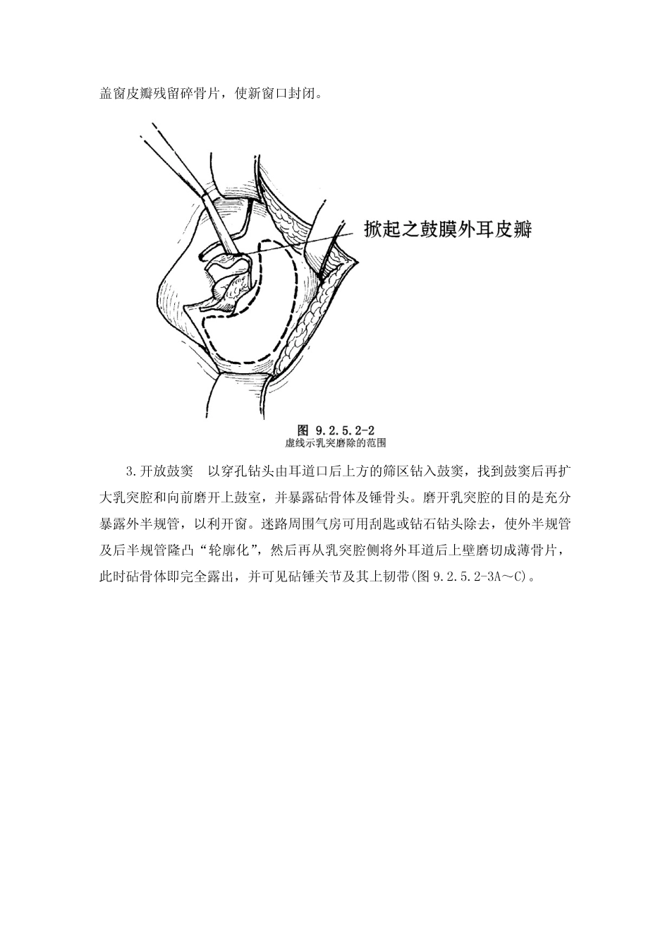 手术_9.2.5.2 内耳开窗术_第3页